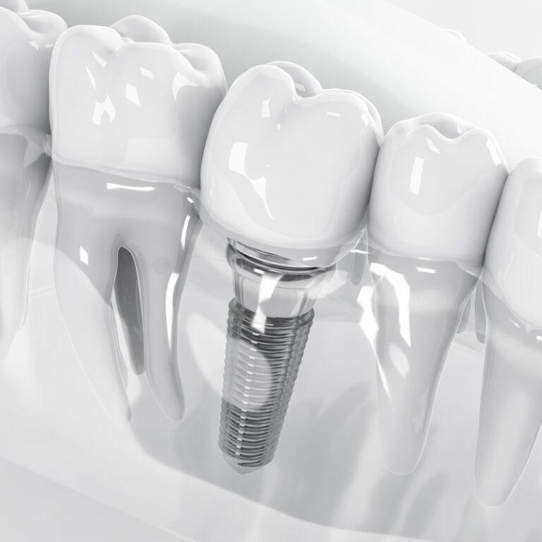 Dental Implants The Windsor Dental Practice Dentist Leicester