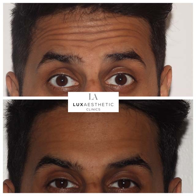 anti-wrinkle treatment before and after