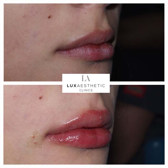 lip enhancement before and after