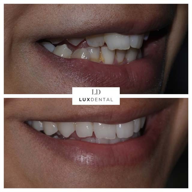 Invisalign® before after