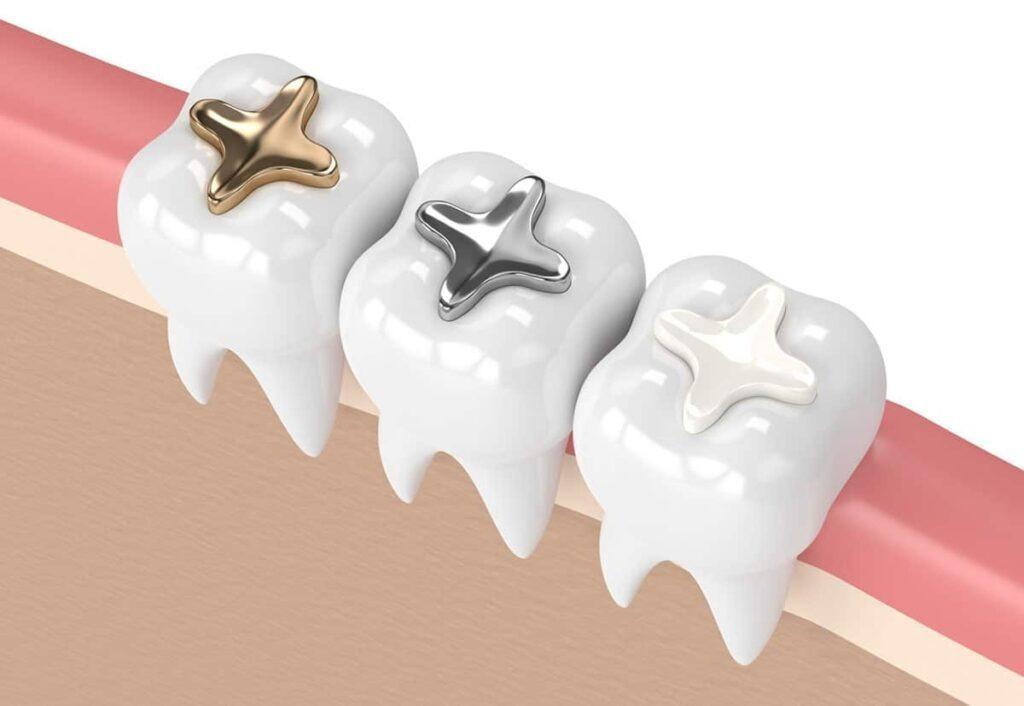 Dental Filling