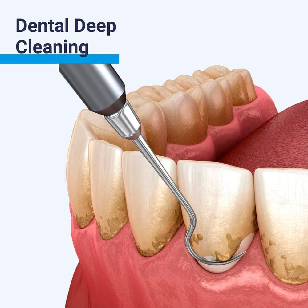 teeth cleaning