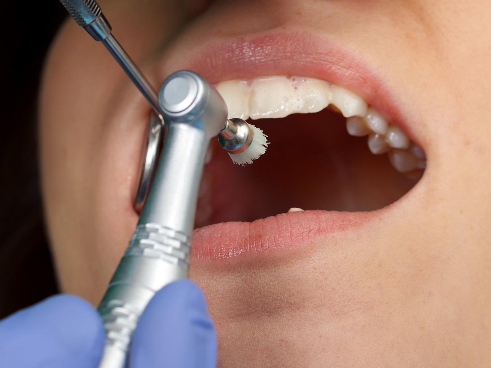 teeth cleaning