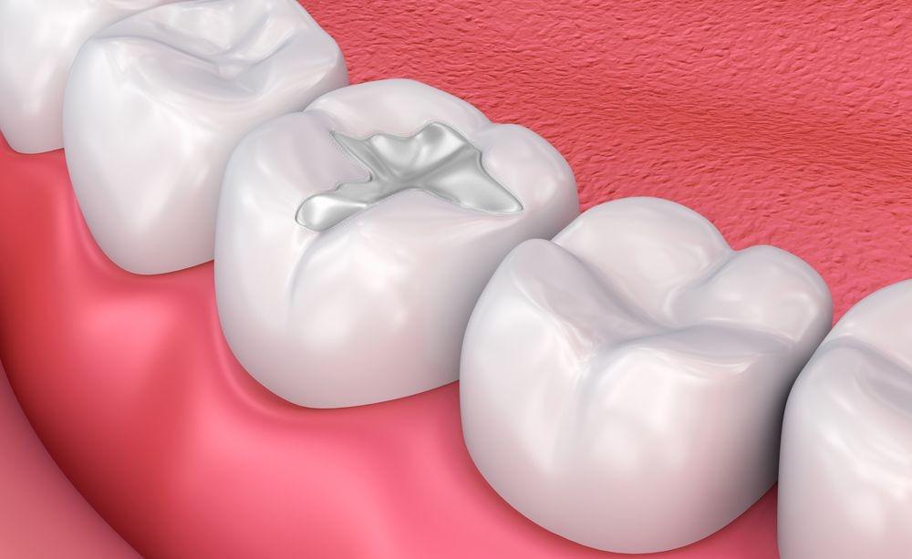 Dental Filling