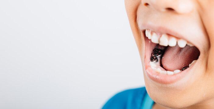 Dental Filling