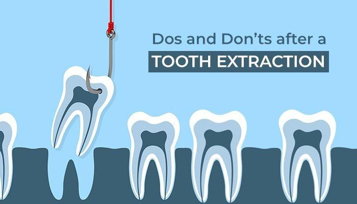 tooth extraction