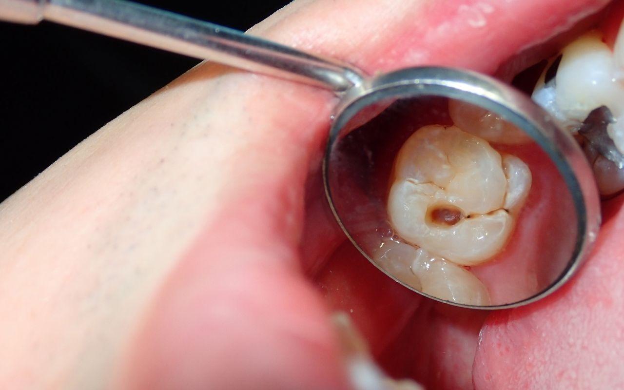 Dental Filling