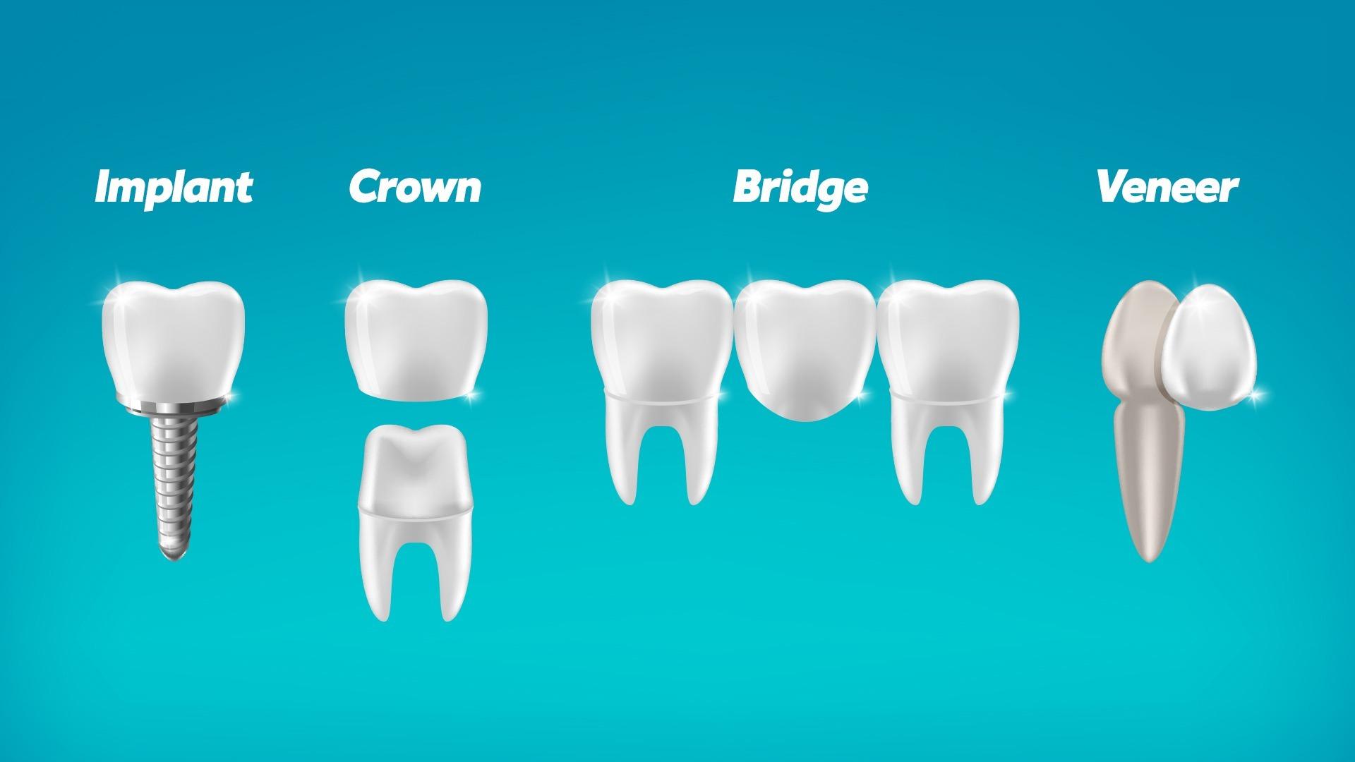 dental implant