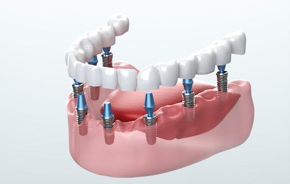 dental implant