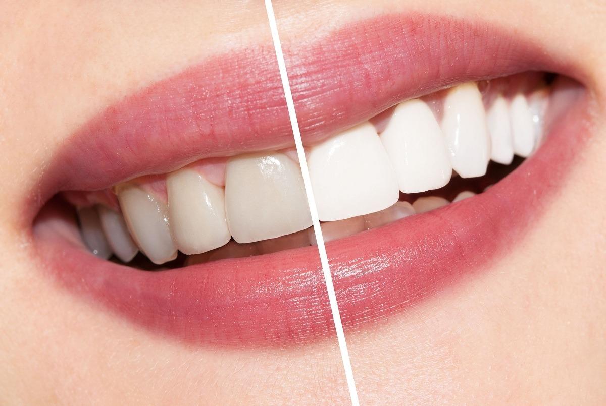 teeth whitening leicester