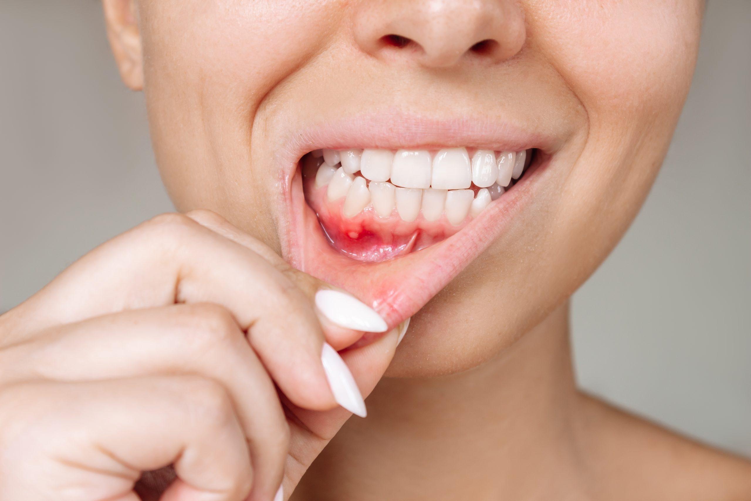 Preventing Gingivitis