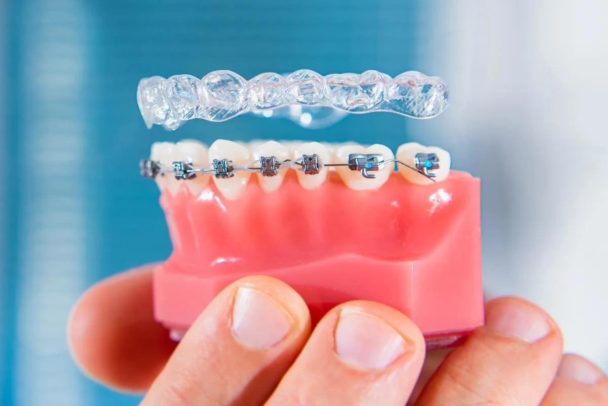 Clear Aligners