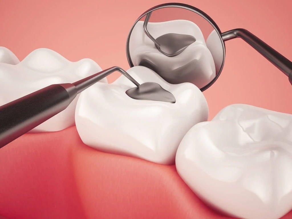 Dental Sealants