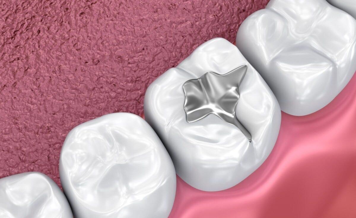 Dental Sealants