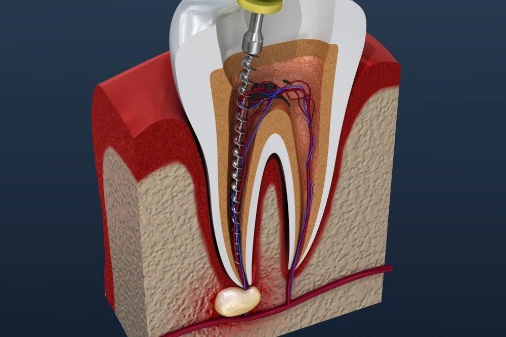 Root Canal After Care