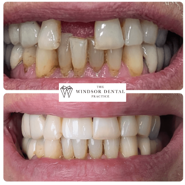 dental implant smile