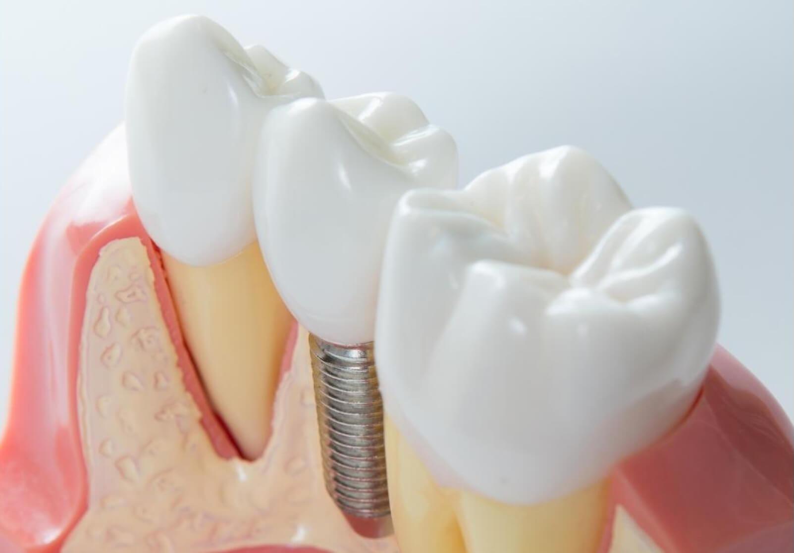 Reasons Behind the High Price of Dental Implants in the UK