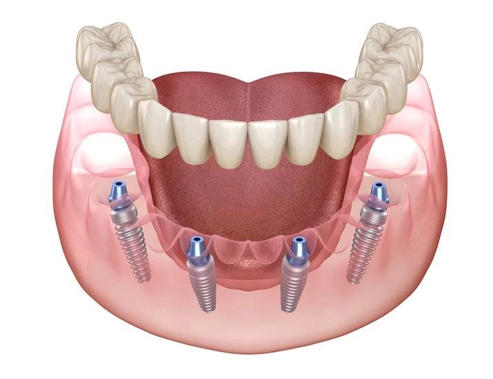 dental implant