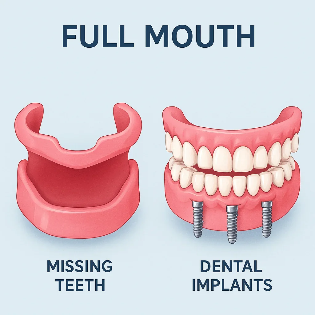 full dental implant