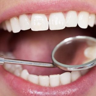 Dentist examining a tooth before placing a white composite filling in Leicester