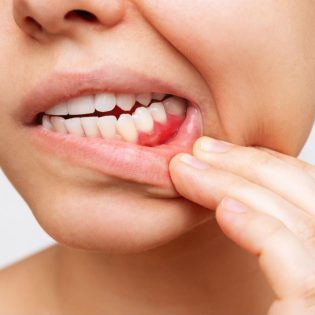 Woman showing bleeding gums – sign of gum disease requiring treatment in Leicester