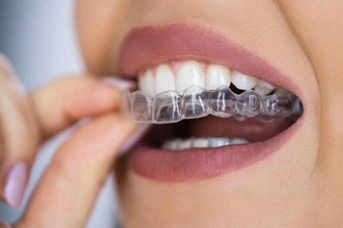 Invisalign treatment in Leicester with clear aligners at The Windsor Dental Practice