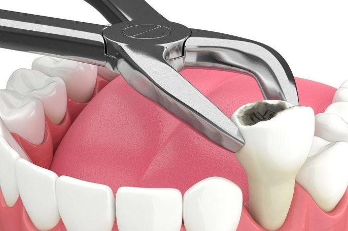 3D illustration of dental forceps removing decayed tooth during extraction procedure at Windsor Dental Leicester